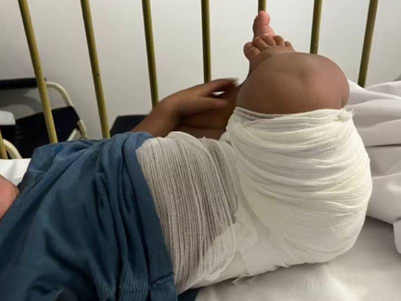 Bebê de 11 meses sofre queimaduras durante banho em creche de Jaú