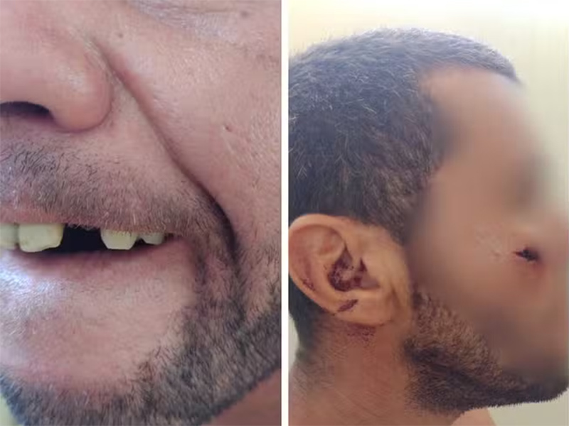 Homem perde dente ao ser agredido com barra de ferro por seguranças em supermercado de Araçatuba
