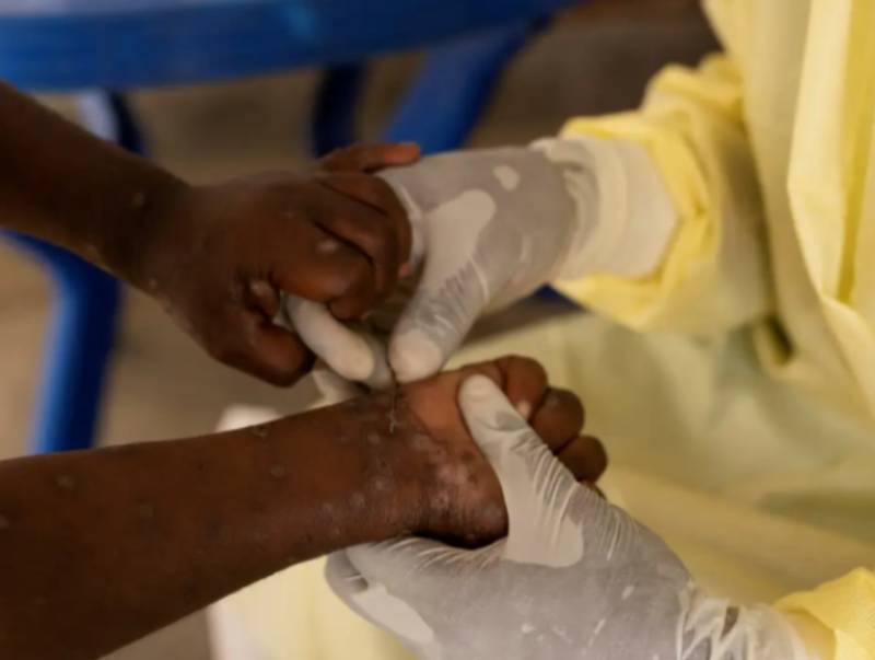 Brasil registra 88 casos de Mpox em 2026; saiba como evitar a doença