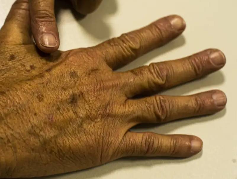 Desinformação sobre câncer de pele afeta diagnóstico, diz instituição