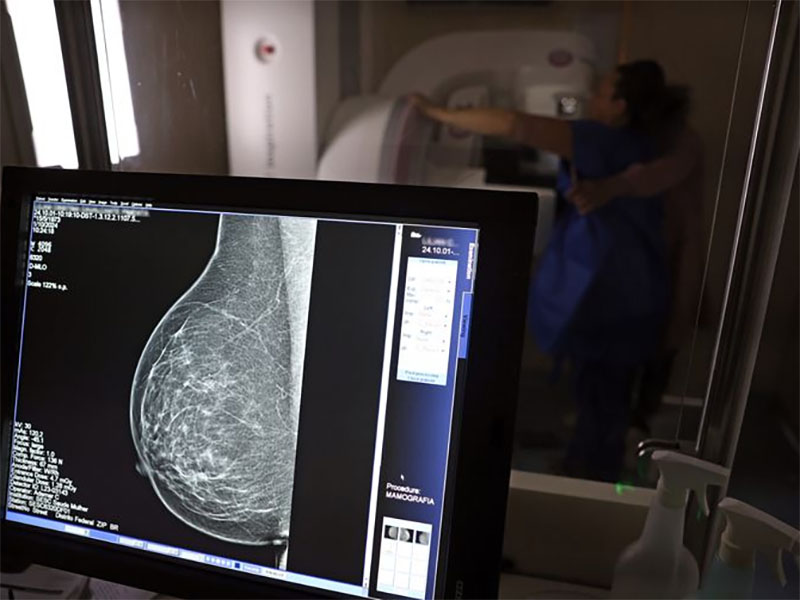 Entidades médicas pedem faixa etária maior para mamografia de rastreio