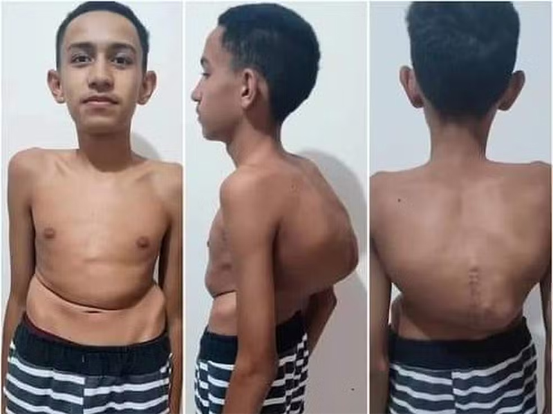 Família de menino com coluna que ultrapassa 100 graus de curvatura luta por cirurgia