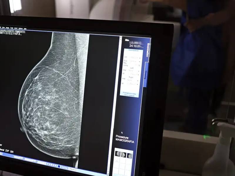 Falta de acesso a mamógrafos limita prevenção do câncer de mama
