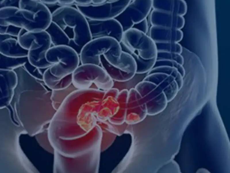 Pacientes com câncer colorretal são diagnosticados em estágio avançado