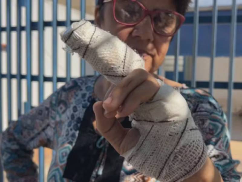 Mulher tem parte do dedo decepado após ataque de pitbull em Marília