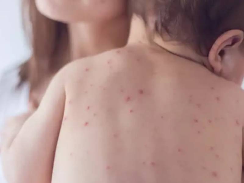 Estado de São Paulo reforça necessidade de vacinação contra o sarampo