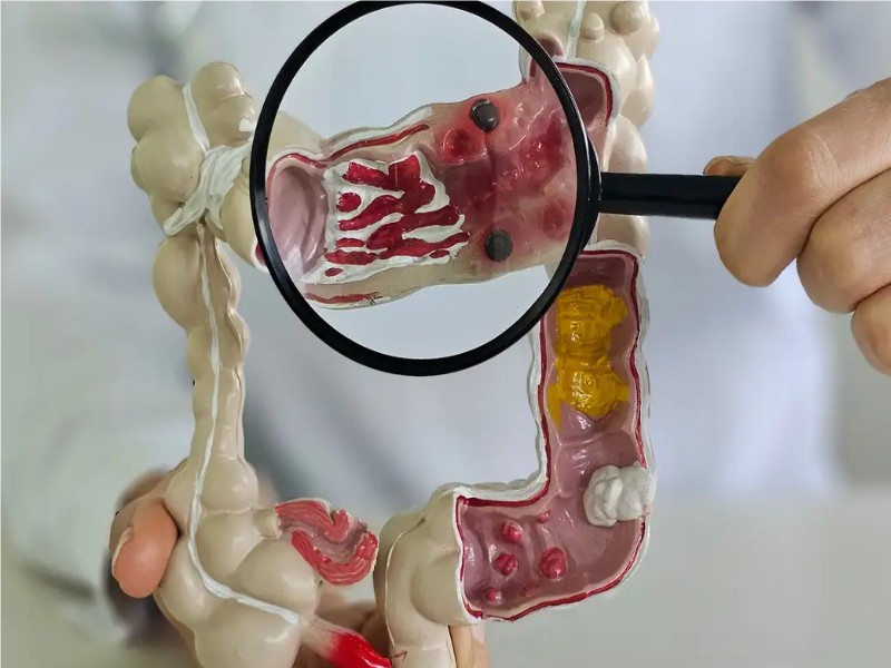 Em 13 anos, doença inflamatória intestinal cresce 5 vezes no Brasil